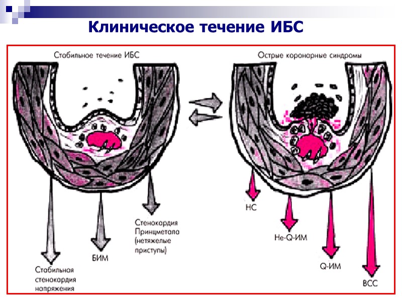 Клиническое течение ИБС